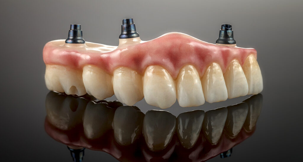 dental implants